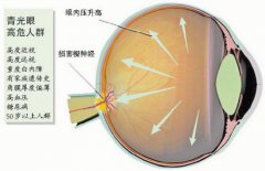 视野缺损 小心青光眼