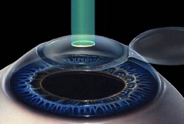 准分子激光近视手术有年龄限制吗?